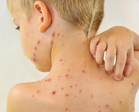 Вспышка кори.В Кыргызстане в 2024-м году скончались двое детей