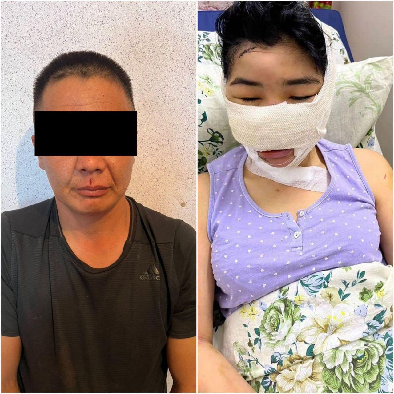 Кулак мурду кесилип, зомбулук көргөн Асель Ногойбаева мурдагы күйөсү түрмөдөн коркутуп жатканын билдирди